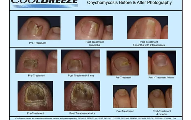 coolbreeze laser for toenail fungus